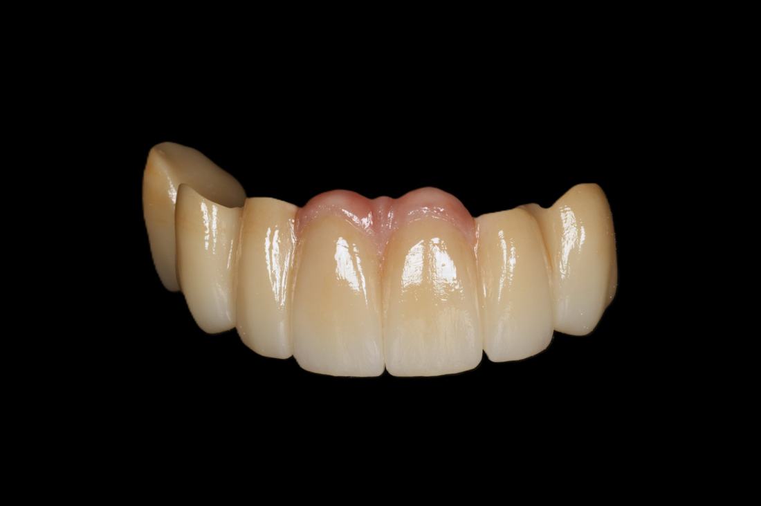 Anterior bridge