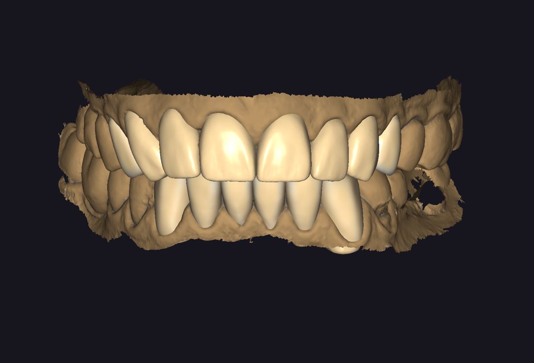 Digital smile design, upper and lower