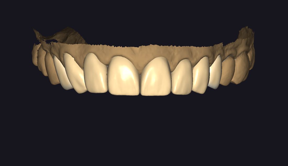Digital smile design