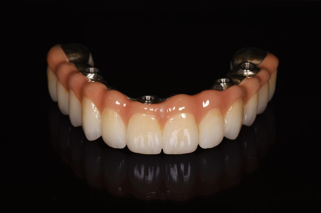 Full-arch implant bridge