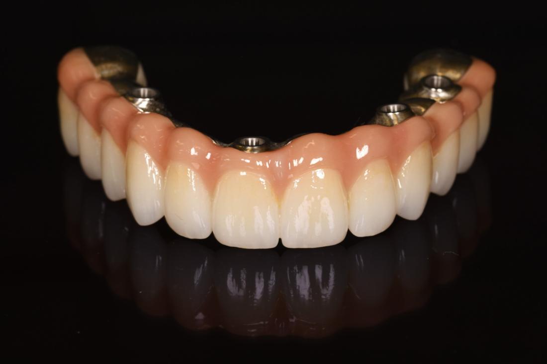 Full-arch implant bridge