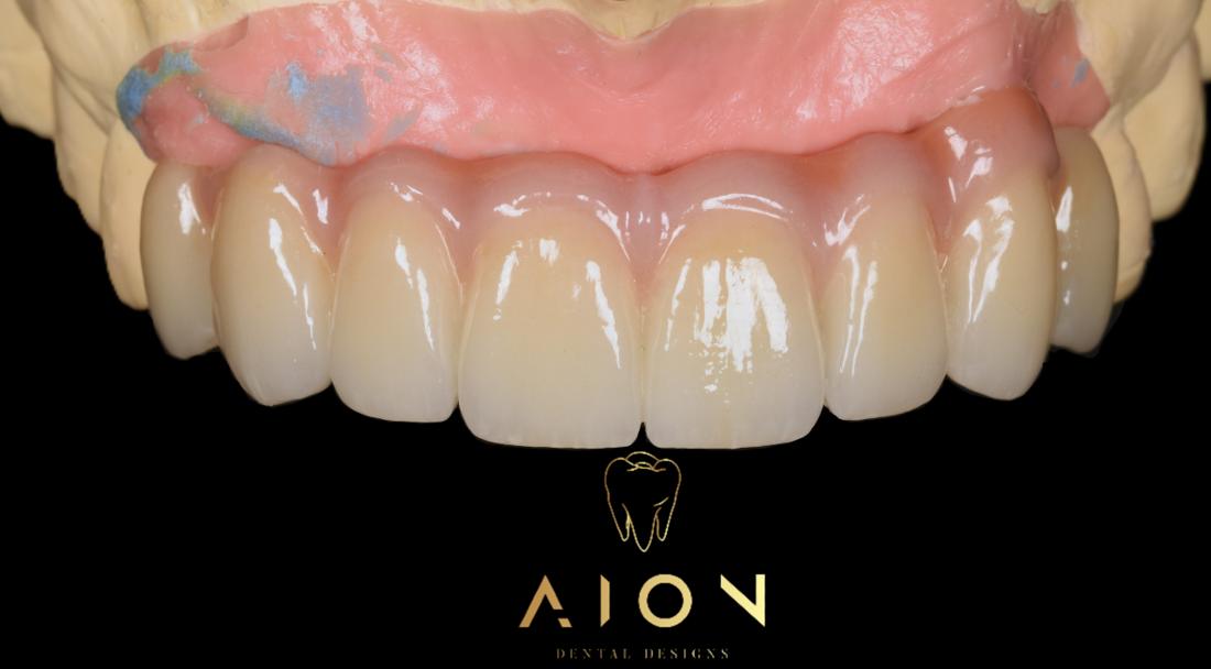 Full-arch restoration