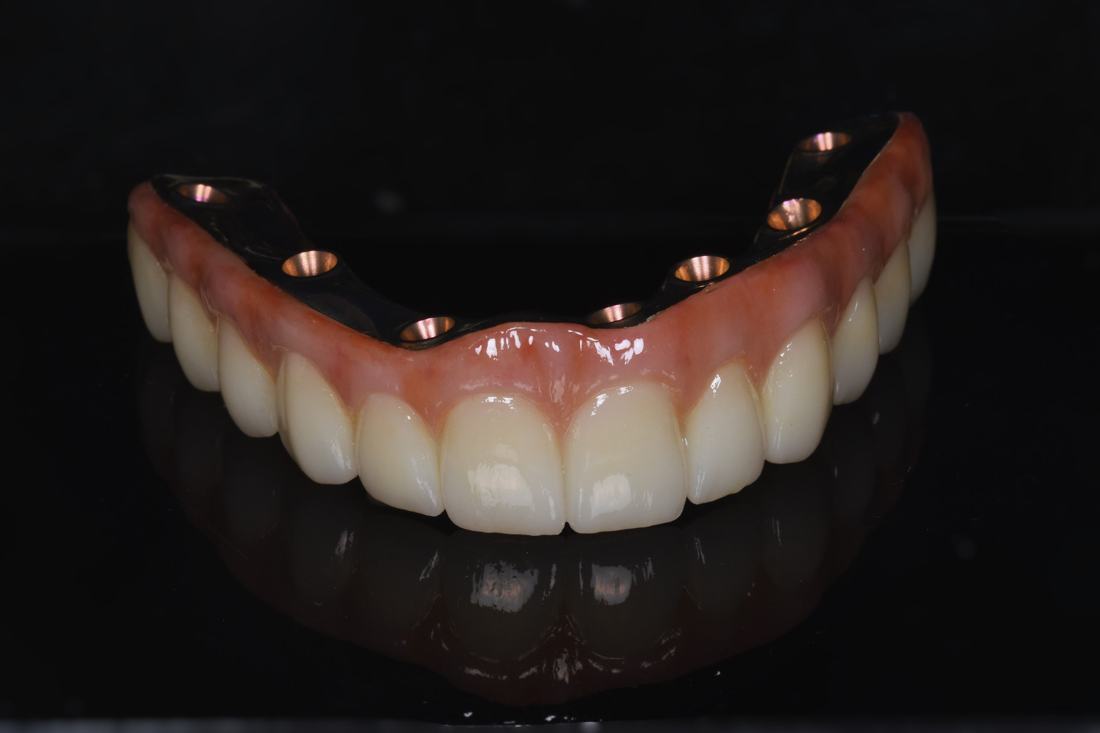 Full-arch restoration with bar