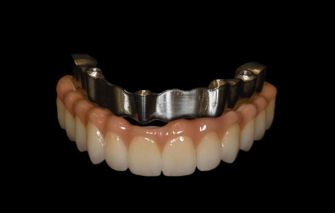 Full-arch restoration with bar