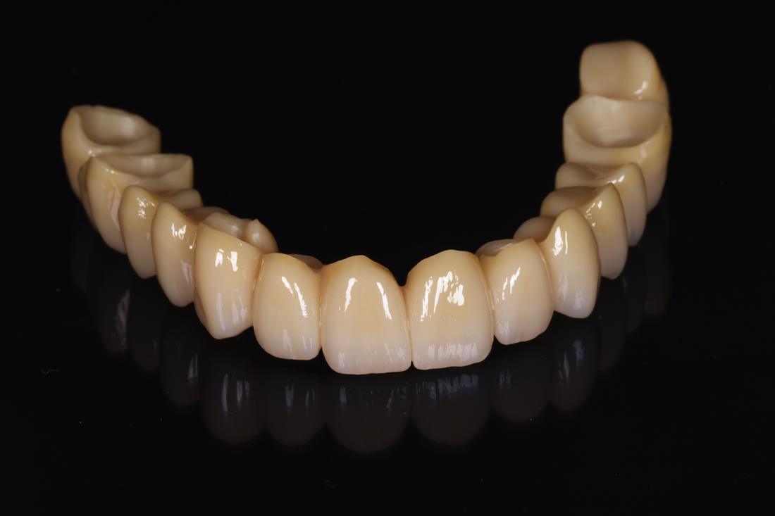 Full-arch restoration