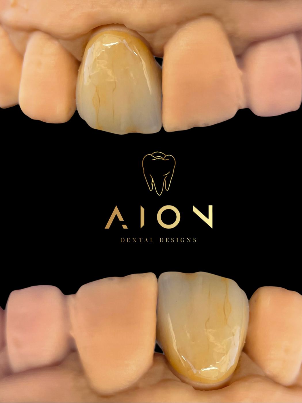 Hand-finished anterior crown