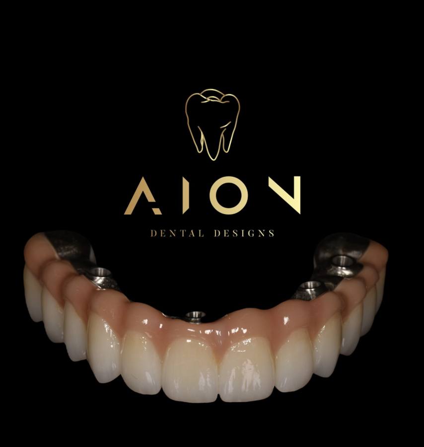 Implant bridge on metal framework