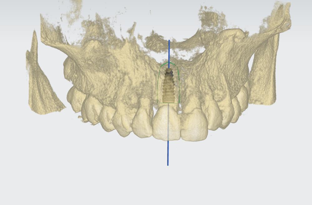 Implant planning with CBCT