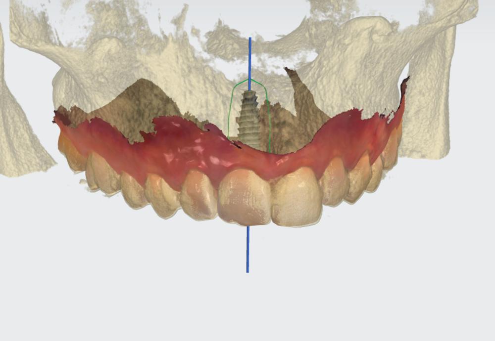 Implant planning with CBCT