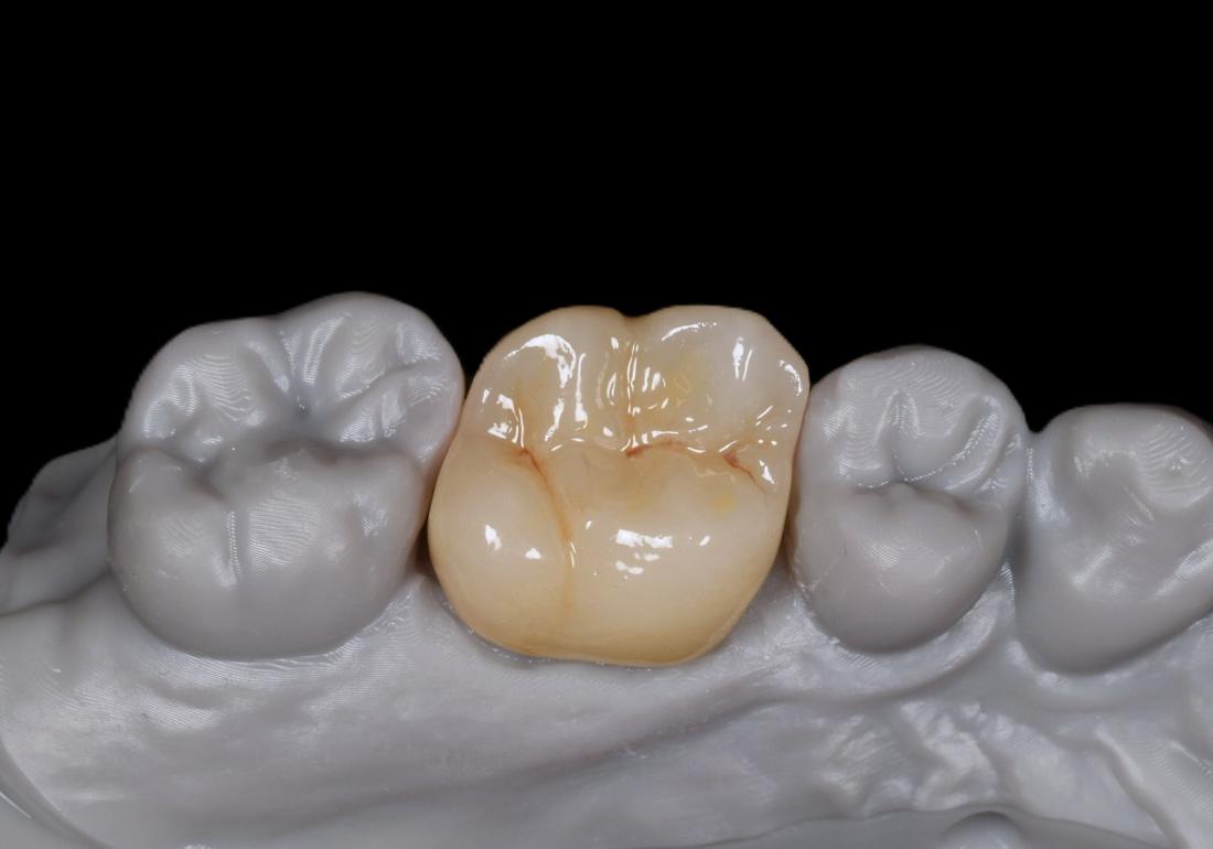 Molar crown