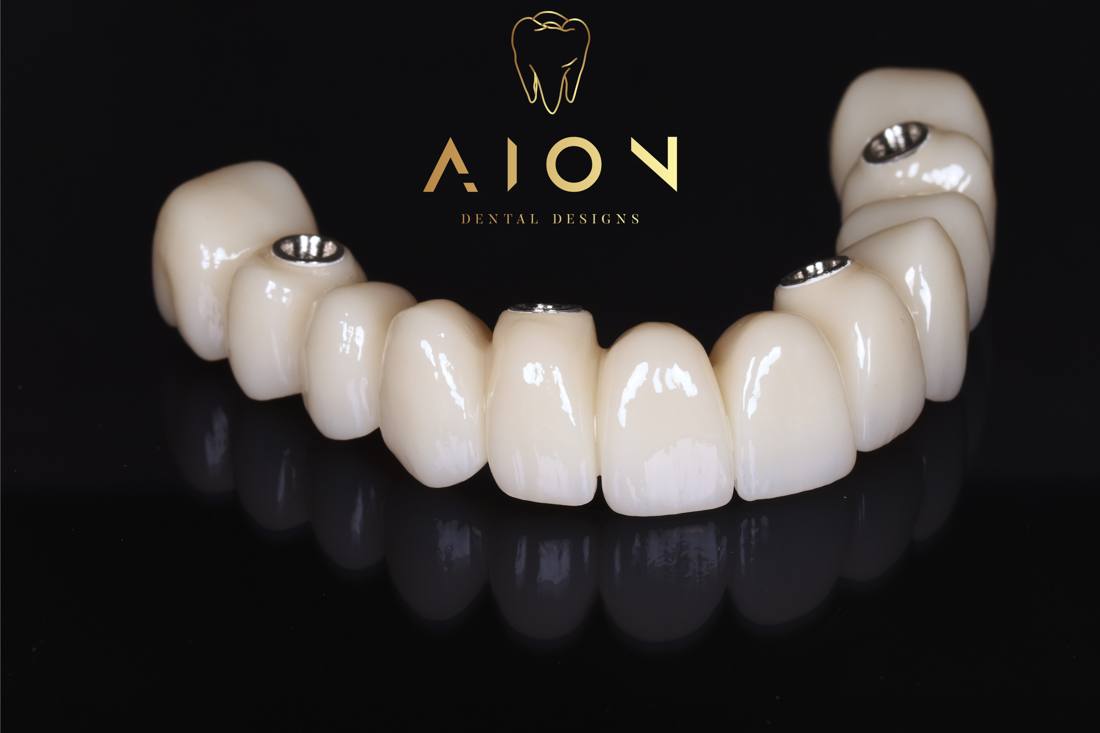 Screw-retained implant bridge