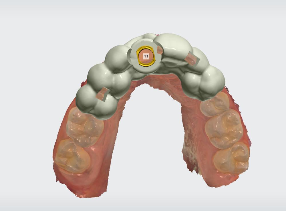 Surgical guide design