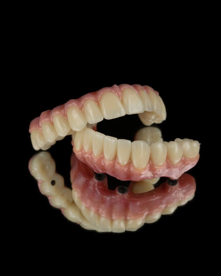 Upper and lower implant restorations